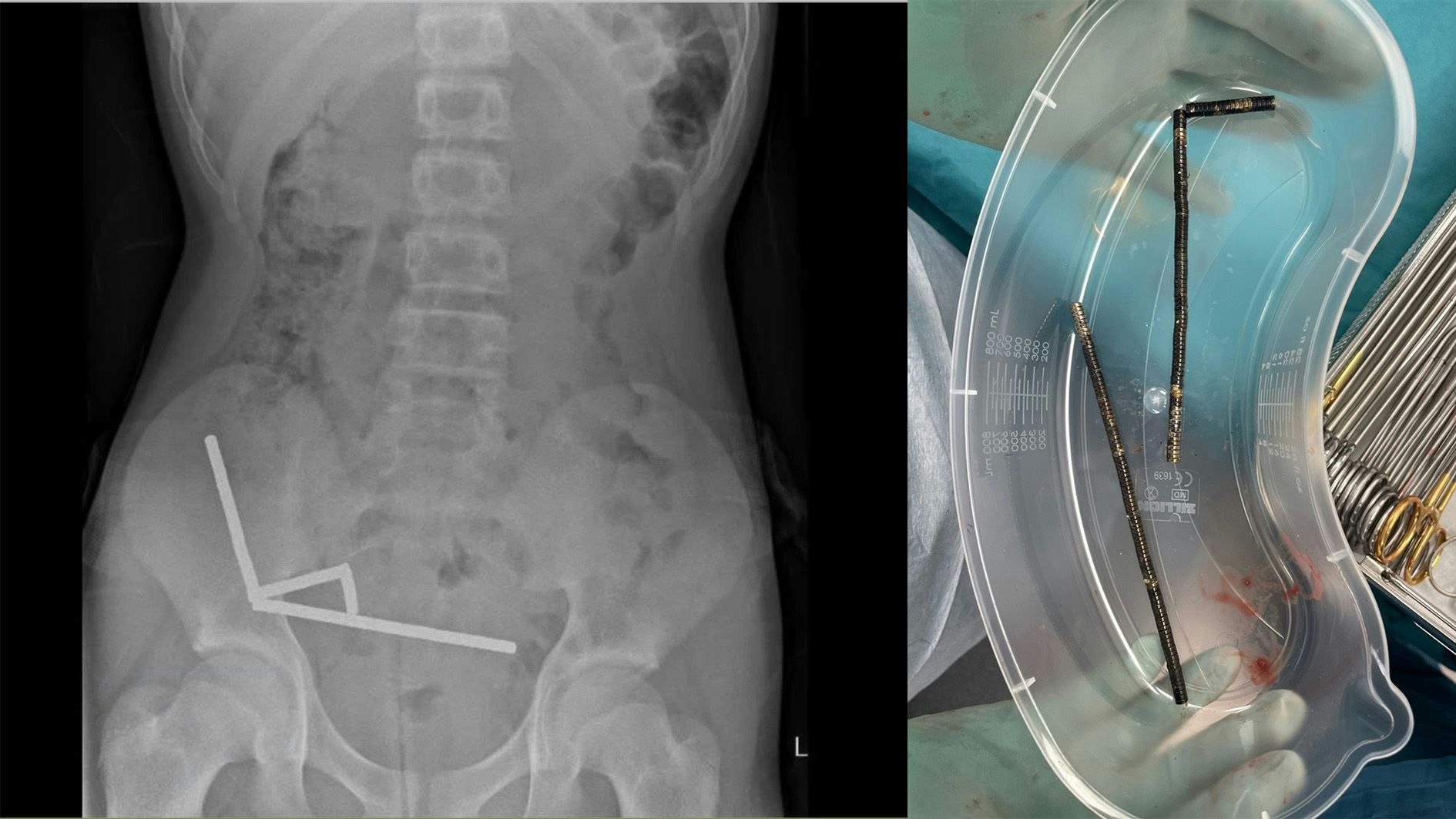 Heute.at - 100 Magnete geschluckt: 13-Jähriger in Not-OP gerettet