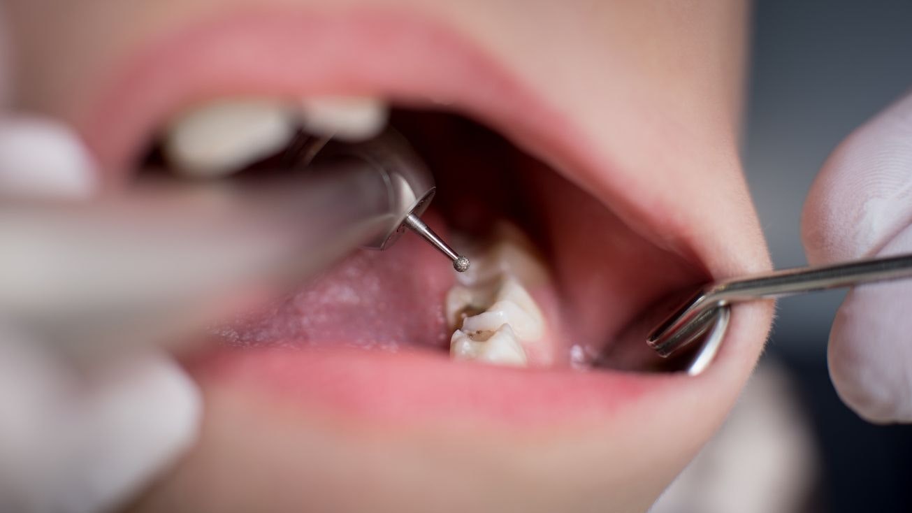 Heute.at - Sophia (6) stirbt während Narkose beim Zahnarzt